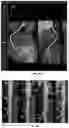Fig. 36 - Systems, methods, and devices for medical image analysis, diagnosis, risk stratification, decision making and/or disease tracking