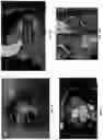 Fig. 39 - Systems, methods, and devices for medical image analysis, diagnosis, risk stratification, decision making and/or disease tracking