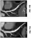 Fig. 58 - Systems, methods, and devices for medical image analysis, diagnosis, risk stratification, decision making and/or disease tracking