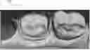 Fig. 01 - Tooth segmentation using tooth registration