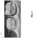 Fig. 04 - Tooth segmentation using tooth registration