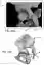 Fig. 17 - Systems and methods for intra-operative pelvic registration
