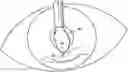 Fig. 01 - Expansion ring for eyeball tissue