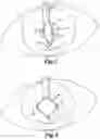 Fig. 03 - Expansion ring for eyeball tissue