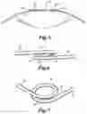 Fig. 04 - Expansion ring for eyeball tissue