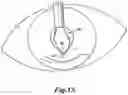 Fig. 11 - Expansion ring for eyeball tissue