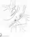 Fig. 03 - Suturing device, in particular for suturing lacerations of the meniscus