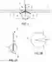 Fig. 02 - Self-assembling suture anchor assembly, surgical kit, and surgical repair method