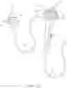 Fig. 03 - Endoscopic suture cinch