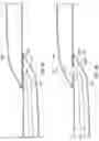 Fig. 06 - ANASTOMOSIS DEVICES