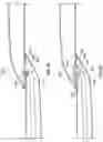 Fig. 07 - ANASTOMOSIS DEVICES