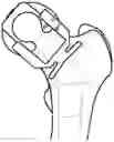 Fig. 01 - INDEXABLE FEMORAL NECK RESECTION GUIDE