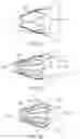 Fig. 13 - DEVICES AND METHODS FOR ASPIRATION OF THROMBUS
