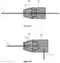 Fig. 15 - Treatment of ischaemia