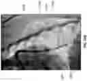 Fig. 40 - Clot removal methods and devices with multiple independently controllable elements