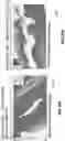 Fig. 45 - Clot removal methods and devices with multiple independently controllable elements