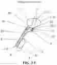 Fig. 10 - DIRECT-VISION ABORTION UTERINE CURETTAGE DEVICE AND SYSTEM