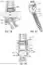 Fig. 20 - Pivotal bone anchor assembly having first and second split rings and an insert with post-placement tool deployment