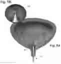 Fig. 06 - Systems and methods for treating the bladder with condensable vapor