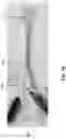 Fig. 20 - CAVITARY TISSUE ABLATION