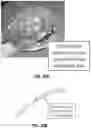 Fig. 21 - CAVITARY TISSUE ABLATION