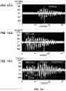 Fig. 10 - Device and method for in vivo detection of clots within circulatory vessels