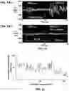 Fig. 11 - Device and method for in vivo detection of clots within circulatory vessels