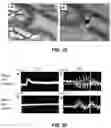 Fig. 17 - Device and method for in vivo detection of clots within circulatory vessels