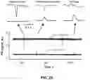 Fig. 19 - Device and method for in vivo detection of clots within circulatory vessels