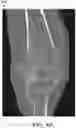 Fig. 05 - ULTRASOUND BASED MULTIPLE BONE REGISTRATION SURGICAL SYSTEMS AND METHODS OF USE IN COMPUTER-ASSISTED SURGERY