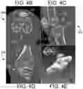Fig. 06 - ULTRASOUND BASED MULTIPLE BONE REGISTRATION SURGICAL SYSTEMS AND METHODS OF USE IN COMPUTER-ASSISTED SURGERY