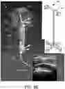 Fig. 14 - ULTRASOUND BASED MULTIPLE BONE REGISTRATION SURGICAL SYSTEMS AND METHODS OF USE IN COMPUTER-ASSISTED SURGERY