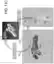 Fig. 22 - ULTRASOUND BASED MULTIPLE BONE REGISTRATION SURGICAL SYSTEMS AND METHODS OF USE IN COMPUTER-ASSISTED SURGERY