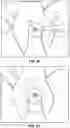 Fig. 12 - TOOL FOR INSERTING AN IMPLANT AND METHOD OF USING SAME