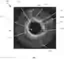 Fig. 02 - Occlusion-crossing devices, atherectomy devices, and imaging