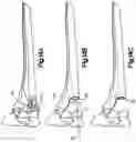 Fig. 12 - Surgical instrument handle with implant sizing feature and method of using