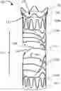Fig. 01 - FLOW RESTRICTING STENT-GRAFT