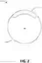 Fig. 03 - FLOW RESTRICTING STENT-GRAFT