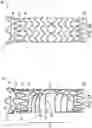 Fig. 04 - FLOW RESTRICTING STENT-GRAFT