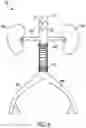 Fig. 11 - FLOW RESTRICTING STENT-GRAFT