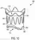Fig. 13 - FLOW RESTRICTING STENT-GRAFT