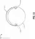 Fig. 14 - FLOW RESTRICTING STENT-GRAFT