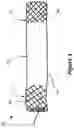 Fig. 02 - APPARATUS AND METHOD FOR FLUID FLOW THROUGH BODY PASSAGES