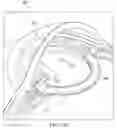 Fig. 05 - FLUID-FILLED HAPTIC FOR AN INTRAOCULAR LENS