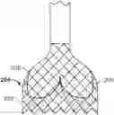 Fig. 01 - Passive alignment of commissures in prosthetic heart valve implantation