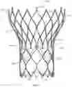 Fig. 02 - Passive alignment of commissures in prosthetic heart valve implantation