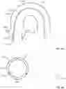 Fig. 05 - Passive alignment of commissures in prosthetic heart valve implantation