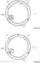 Fig. 06 - Passive alignment of commissures in prosthetic heart valve implantation