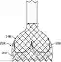 Fig. 01 - Active alignment of commissures in prosthetic heart valve implantation