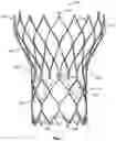 Fig. 02 - Active alignment of commissures in prosthetic heart valve implantation